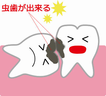親知らずと隣接する歯（第二大臼歯）が虫歯になる