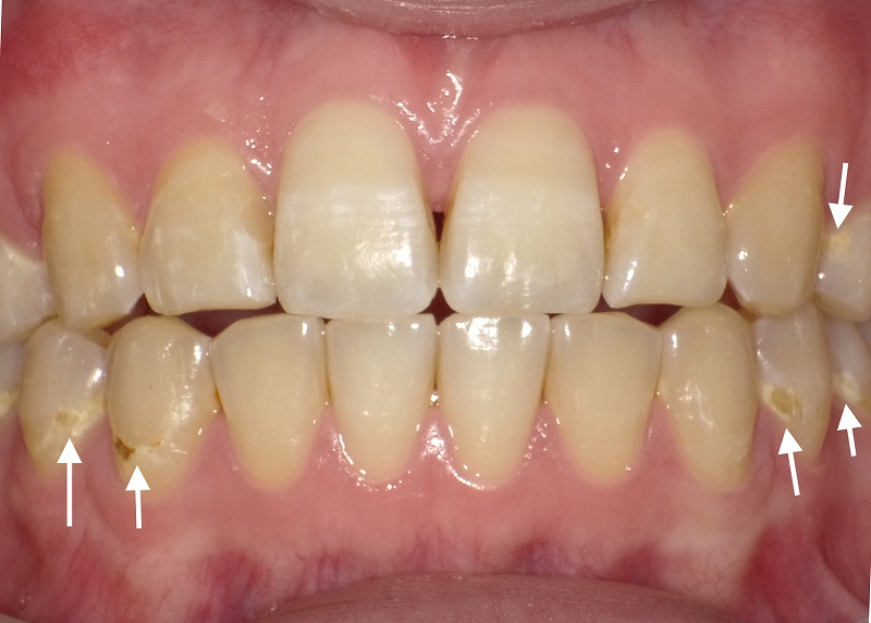 下顎の歯にCO～C1の虫歯発生した症例