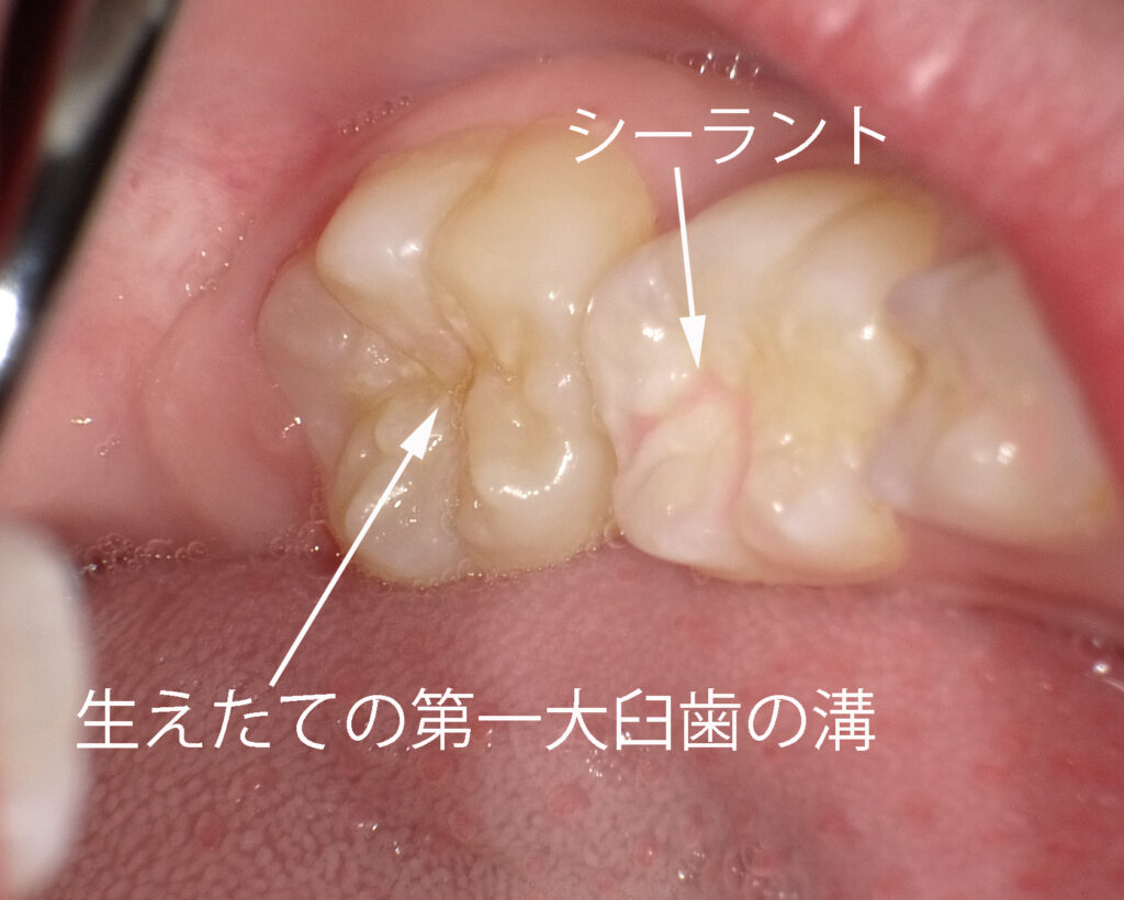 シーラント