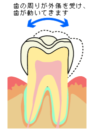歯の動揺を増す要因