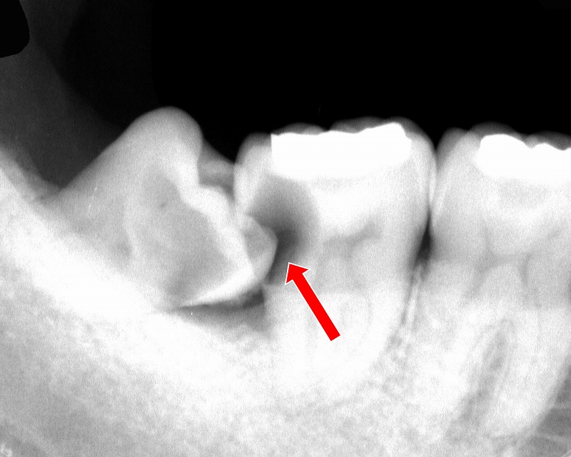 第二大臼歯に虫歯
