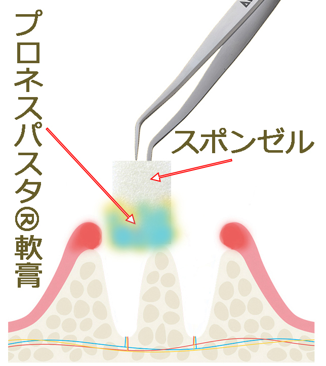 軟膏や詰め物の使用
