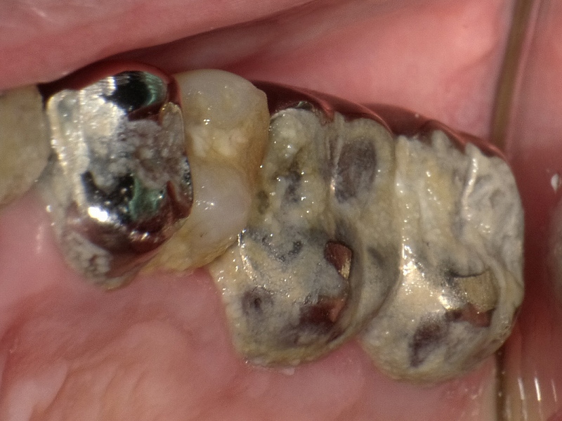 古い歯垢が口腔バイオフィルムを形成