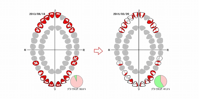 プラークコントロールレコード
