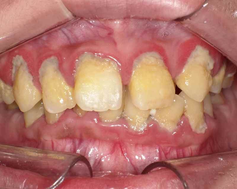 大量の歯石と歯垢が付着