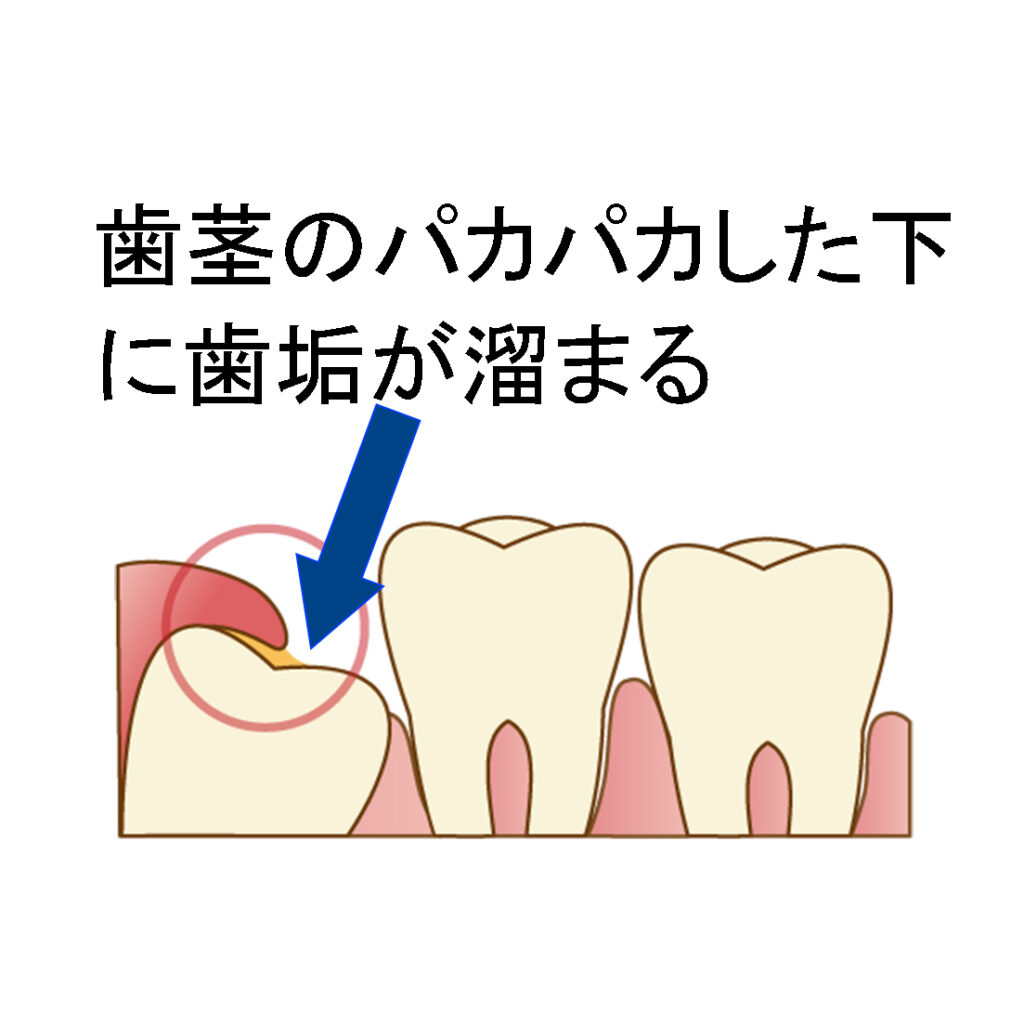 パカパカした歯茎の直下に歯垢が溜まる