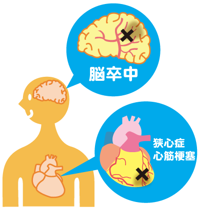 動脈硬化が引き起こす重大リスク