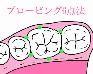 プロービングの測定方法:6点法