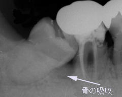 智歯周囲炎が進行し、歯槽骨が吸収される