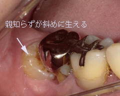 隣の歯が虫歯になる