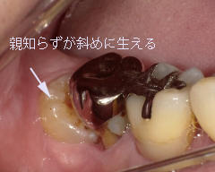 親知らずが斜めに生えたため隣の歯に虫歯が発生