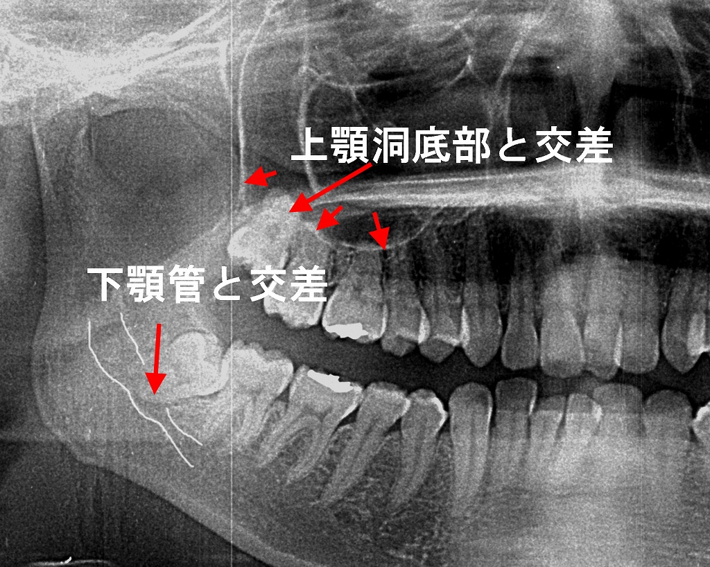 神経に近い親知らず、抜くべき？抜かないべき？判断基準と最新治療