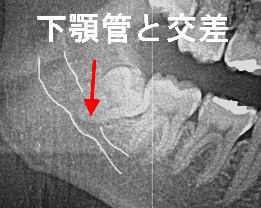 下歯槽神経と親知らずの位置関係