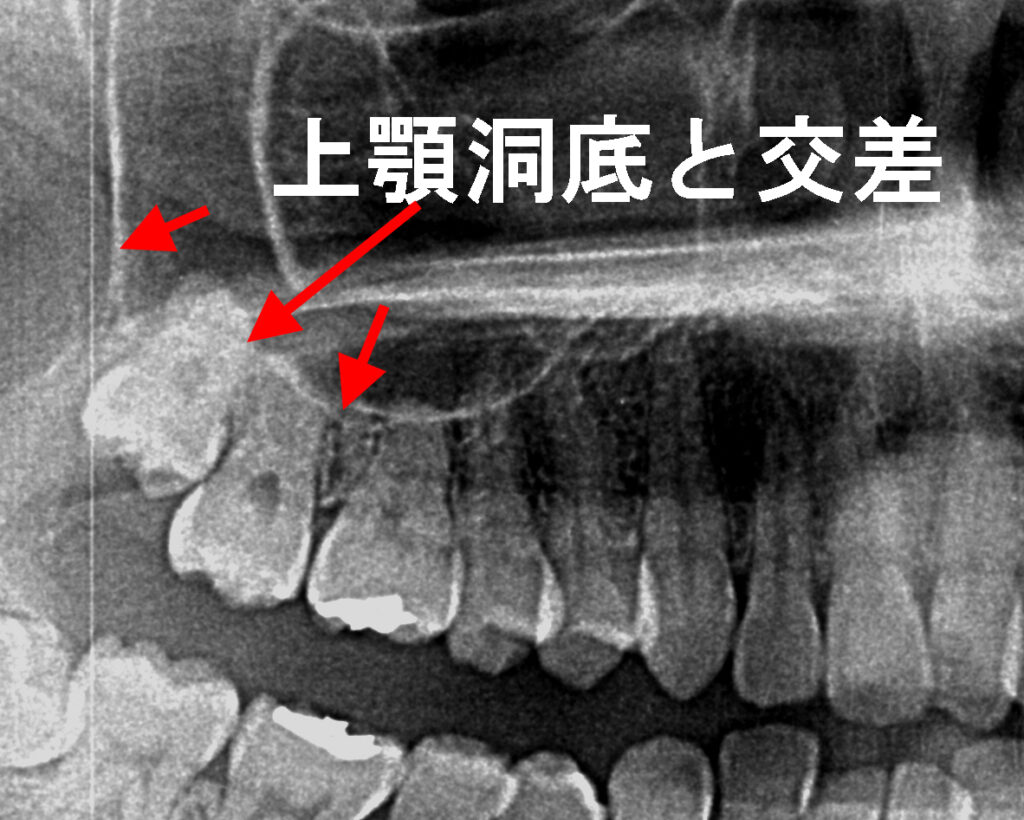 親知らずが上顎洞に迷入するケース