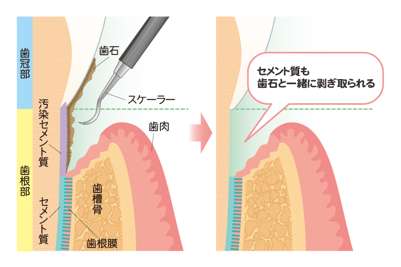 ルートプレーニング