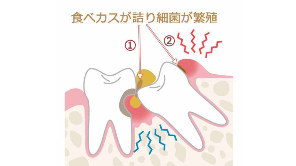 歯垢(プラーク)が増殖し智歯周囲炎へ
