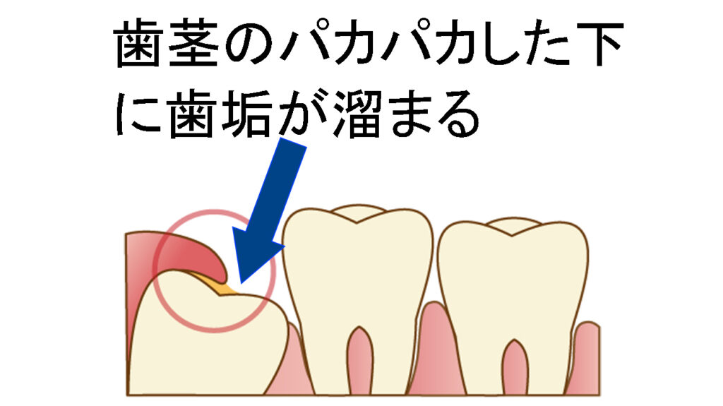 パカパカした歯茎(歯肉弁)