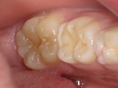 幼弱永久歯（6歳臼歯）