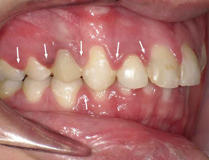 歯肉炎なら歯茎の腫れは自分で治せます