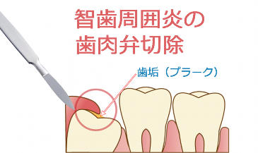 歯肉弁の切除