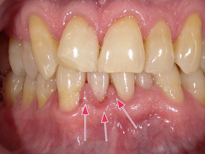 成人の歯肉炎の症例（下顎前歯）