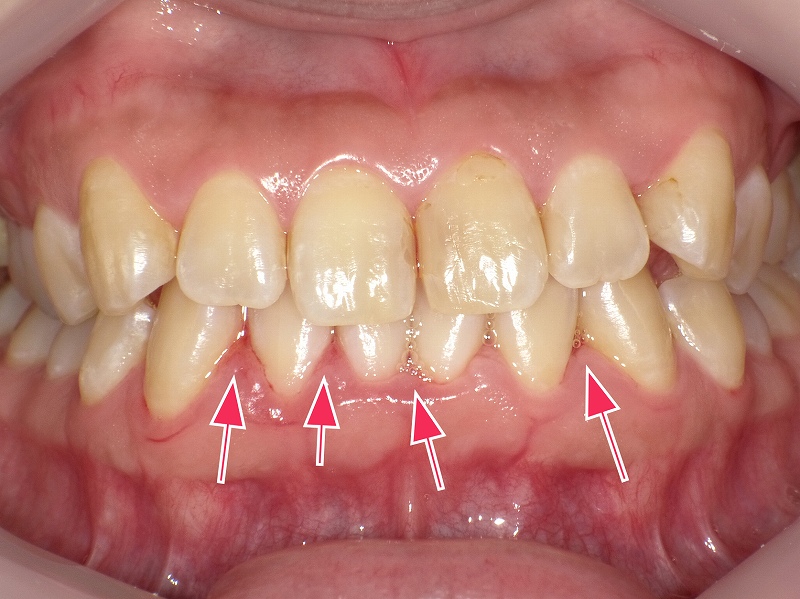 成人の下顎前歯に出来た歯肉炎