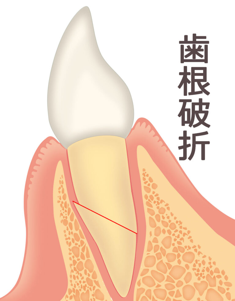 歯根破折で重度の揺れ