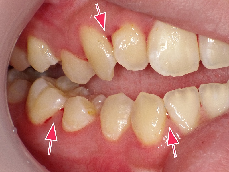 下顎第一大臼歯の歯肉炎