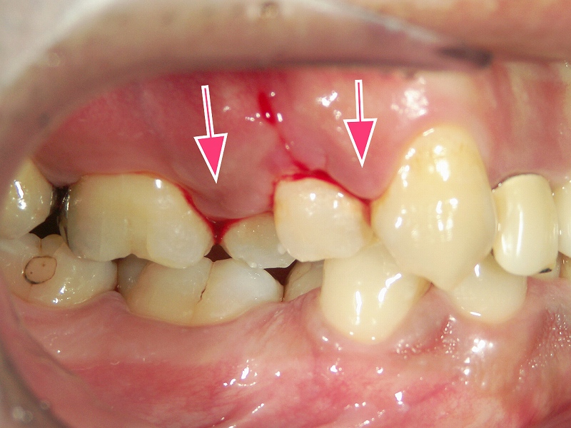 上顎3番～6番に顕著な出血がある歯肉炎