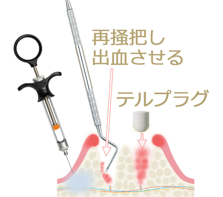 再掻爬処置の目的と注意点