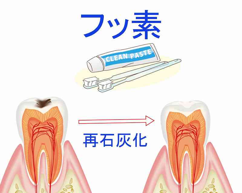 フッ素で初期虫歯を再石灰化し自然治癒