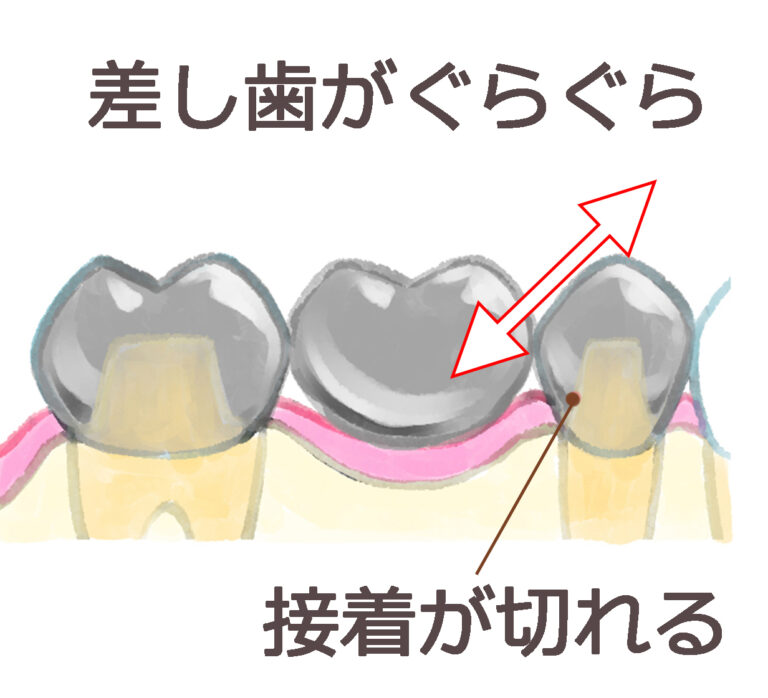 差し歯が外れて歯がグラグラする