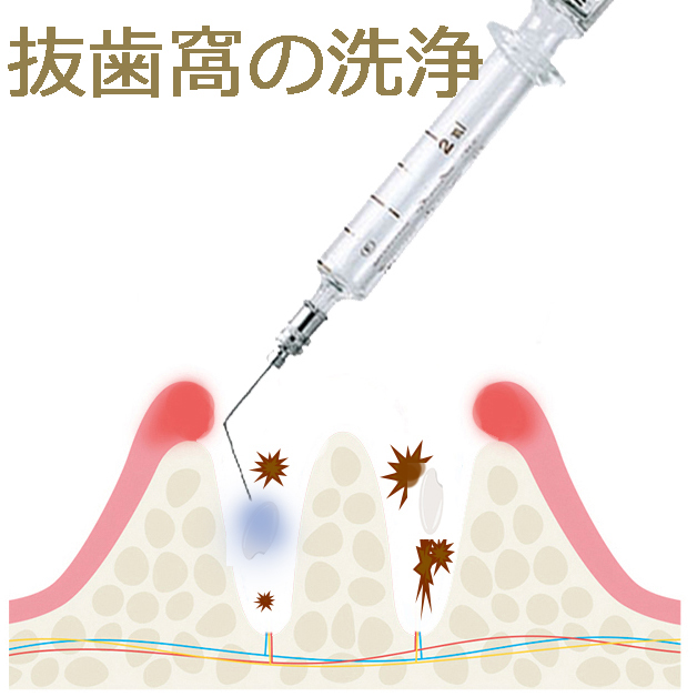 ドライソケット内の洗浄