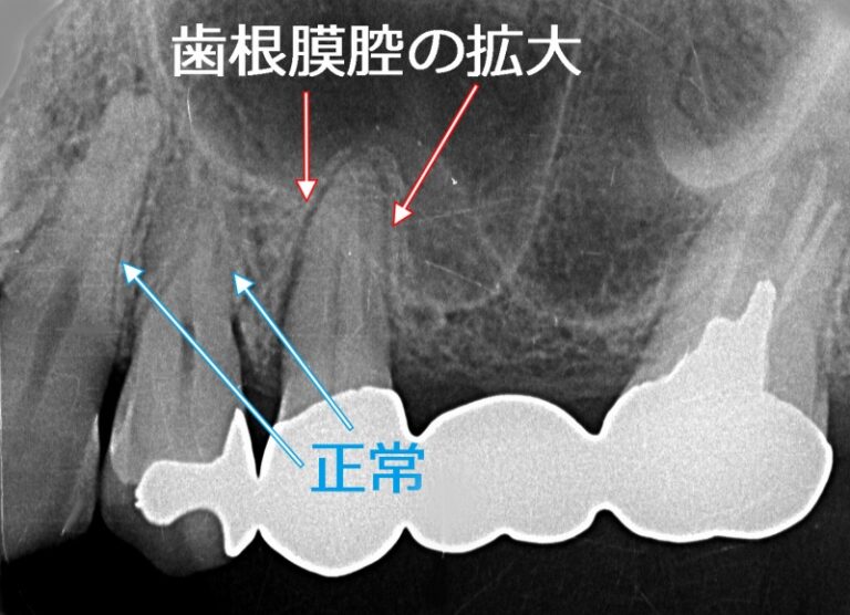 咬合性外傷による歯根膜の拡大