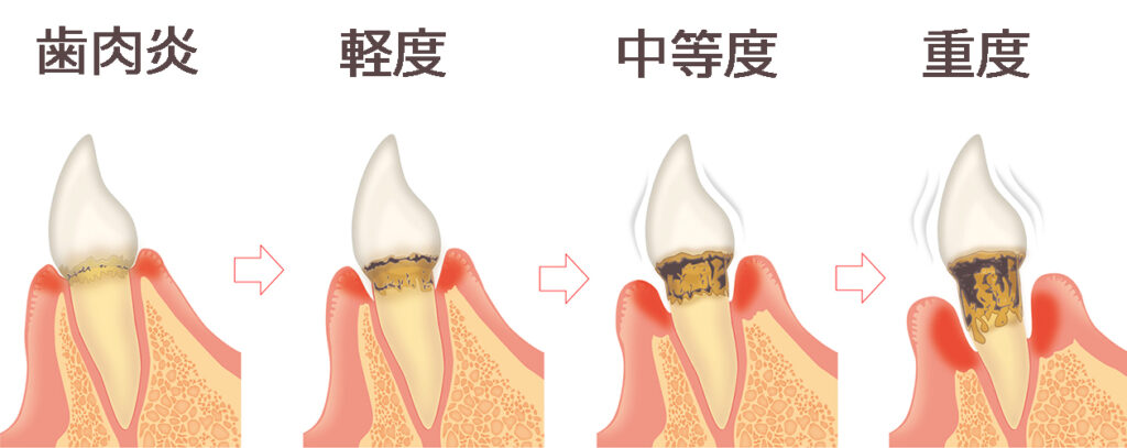 歯周病が進行度と症状