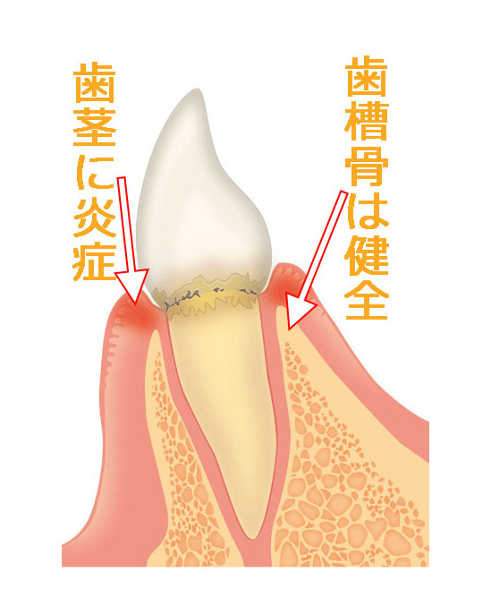 歯肉炎の模式図