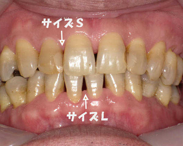 前歯に使う歯間ブラシサイズの例