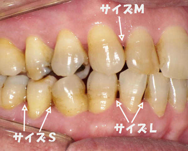 奥歯に使う歯間ブラシサイズの例