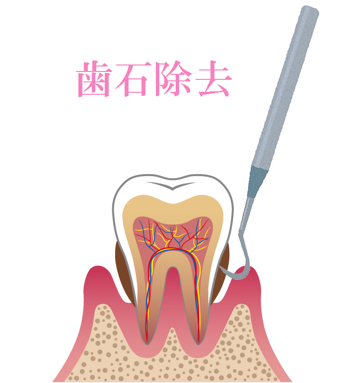 歯石除去などの歯周治療