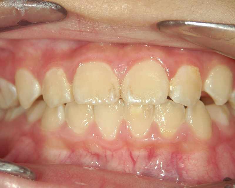 染め出し前の歯垢の付着状態