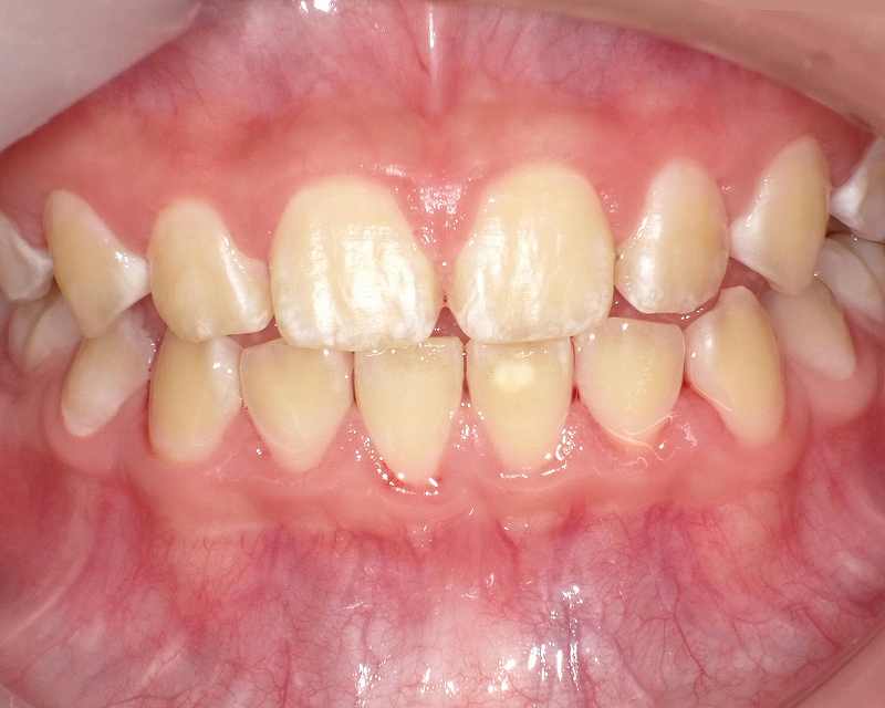 次回来院時の歯垢の付着状態