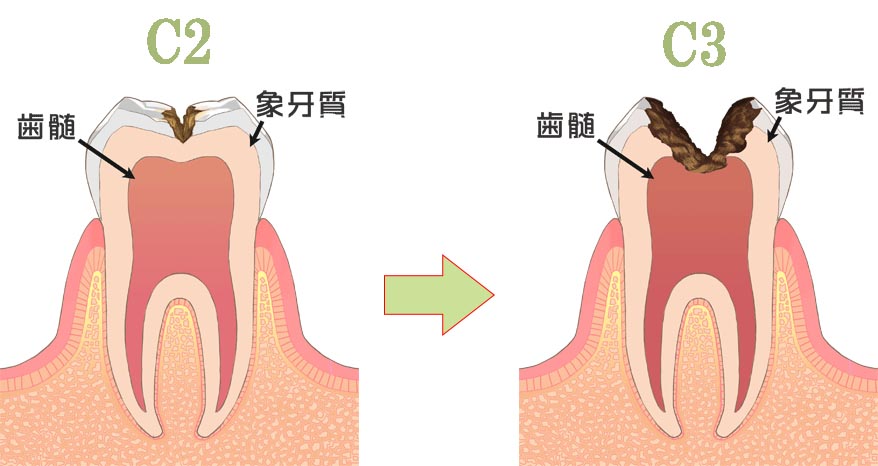 虫歯C2からC3への進行速度