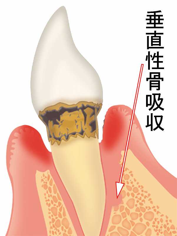 垂直性骨吸収部や大臼歯の分岐部病変