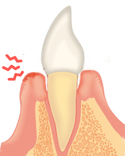 歯石取りの後の歯茎の痛み