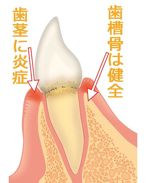 歯肉炎