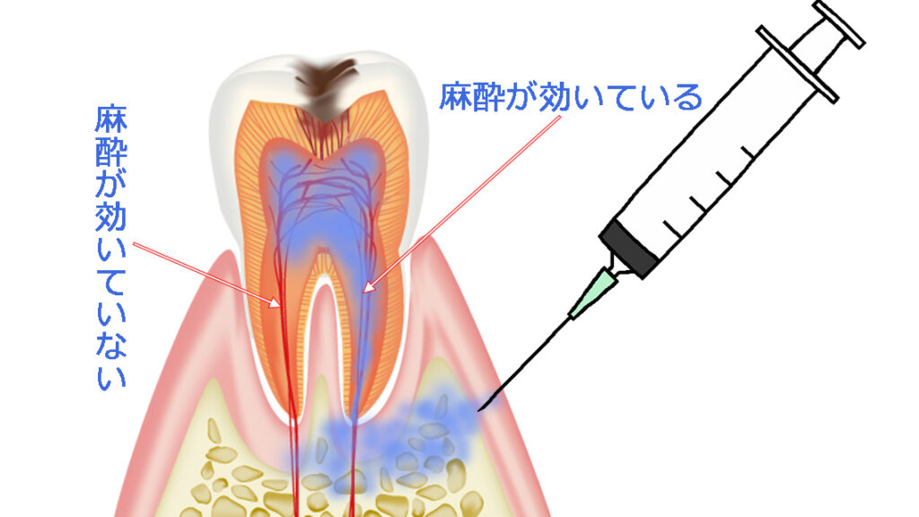 麻酔薬や術中処置による影響