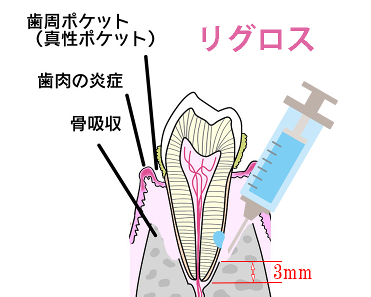 歯周組織再生療法