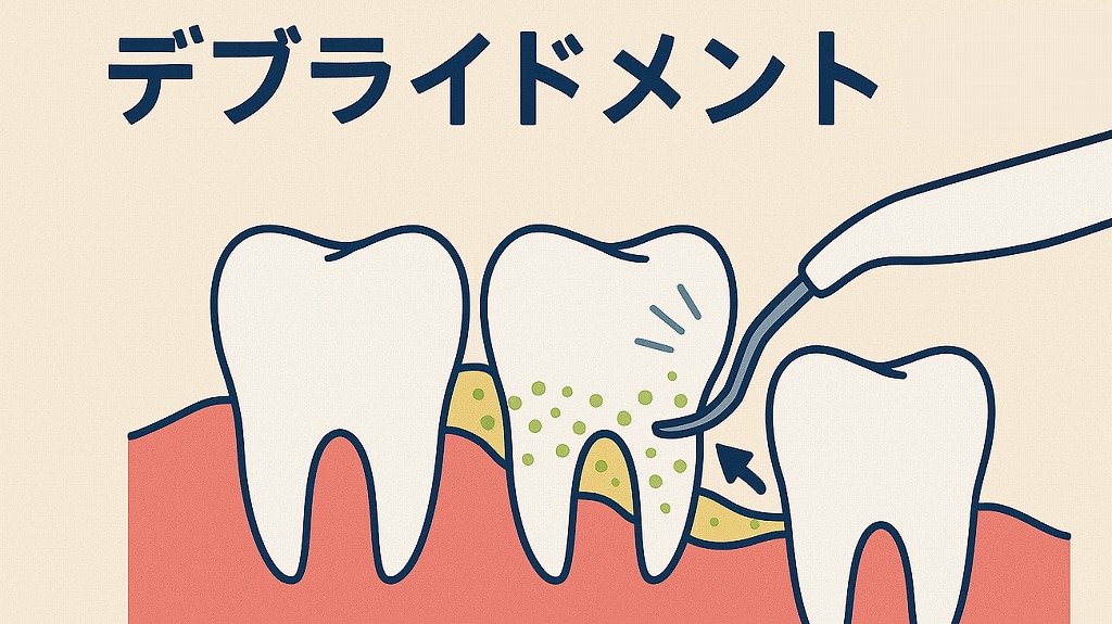 デブライドメン