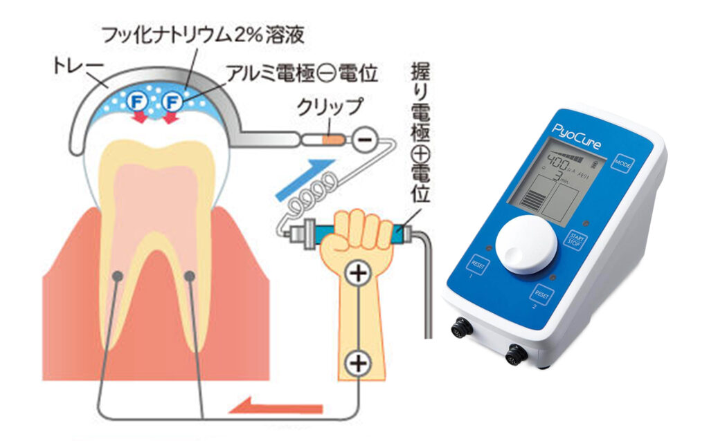 イオン導入器の技術的な仕組み