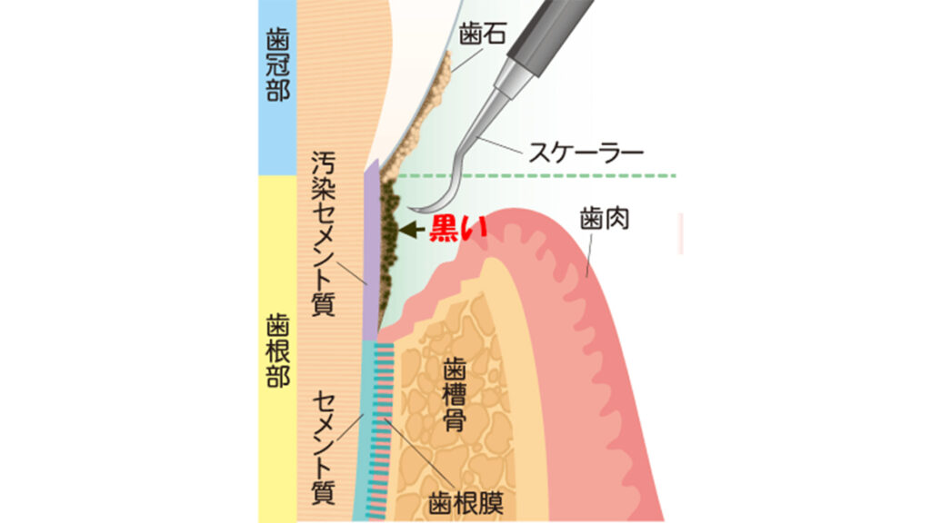 歯石はどうやってできるの?